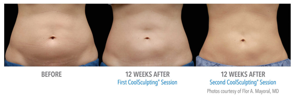 Coolsculpting - A maioria dos pacientes apresenta resultados definitivos e efeitos visíveis entre 1 e 3 meses após o tratamento.