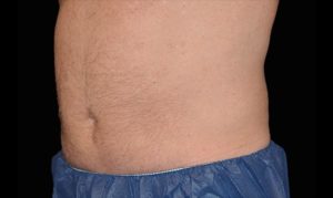 Antes e Depois - abdomen - 15 semanas após o 2.º tratamento CoolSculpting