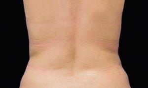 Antes e Depois - costas - 4 semanas após o 2.º tratamento CoolSculpting