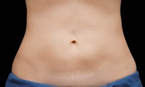Coolsculpting - abdomen - 12 semanas após o 2.º tratamento CoolSculpting